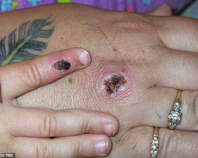 One of the first known cases of the monkeypox virus is shown on a patient's hand on June 5, 2003, in an image released by the Centers for Disease Control and Prevention