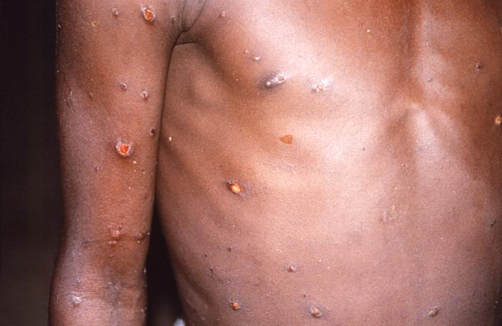 A patient's arms and torso are covered with lesions and sores caused by monkeypox.