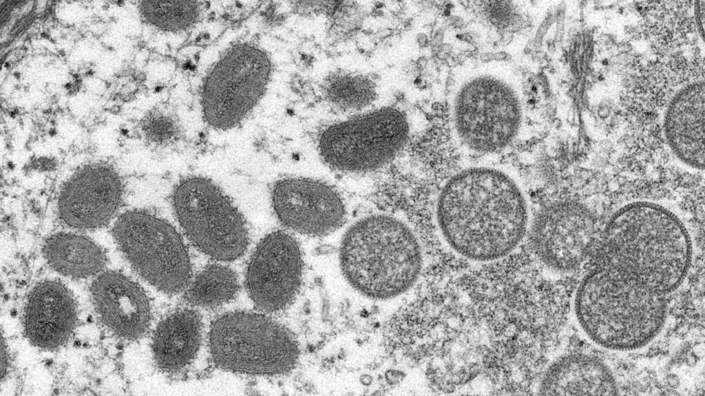 CDC concerned about possible undetected spread of monkeypox in UK

