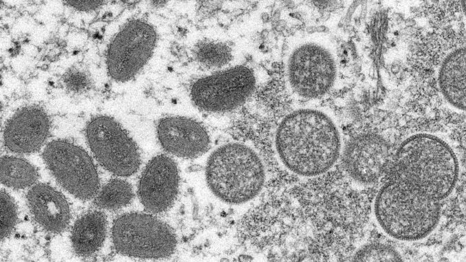 First probable case of monkeypox discovered in Michigan

