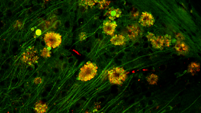 Neural "poison flowers" may be the source of Alzheimer's plaque, study says

