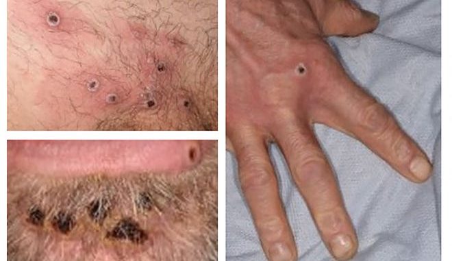 A handout picture made available by the UK Health Security Agency (UKHSA) on 22 June 2022 shows a collage of monkeypox rash lesions at an unknown date and location.