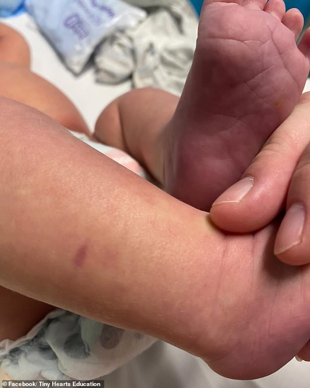 A mother has shared how she was alarmed when she saw a small purple spot on her son's leg, which turned out to be a symptom of meningococcal disease