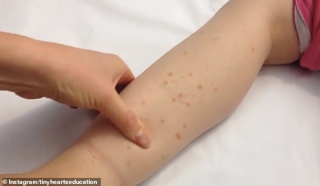 If a rash doesn't turn white for five seconds under pressure from a finger or glass, it could be a sign of a serious illness like meningococcal disease