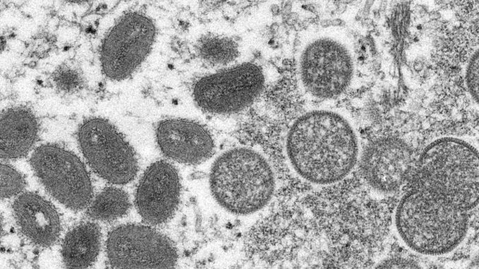 First case of monkeypox confirmed in Montana in Flathead County


