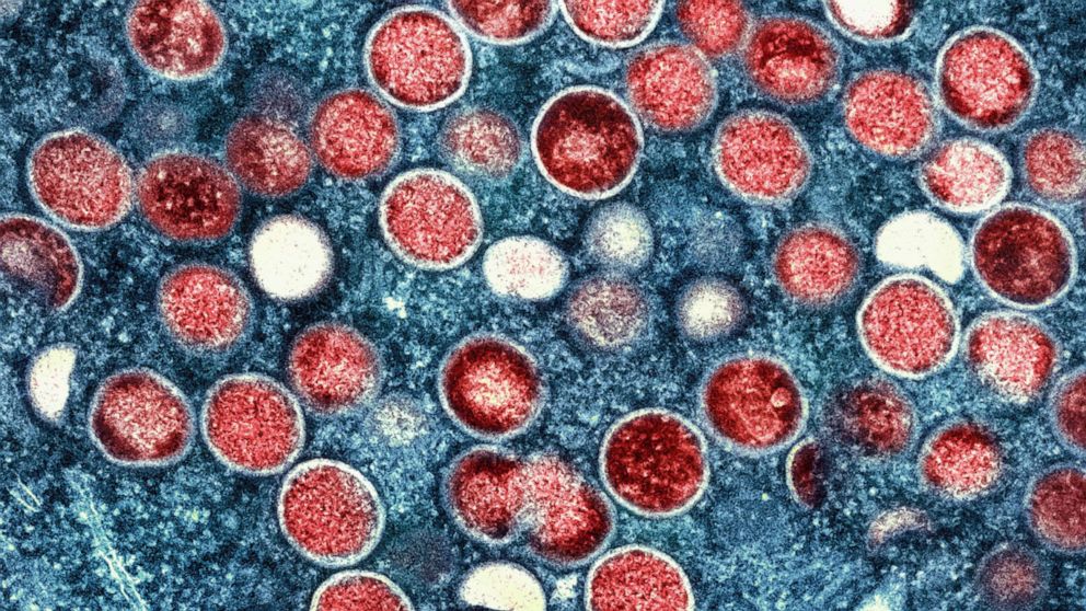 PHOTO: A colorized transmission electron micrograph shows monkeypox particles (red) found in an infected cell (blue) cultured in the laboratory and captured and color-enhanced at the NIAID Integrated Research Facility in Fort Detrick, Maryland.