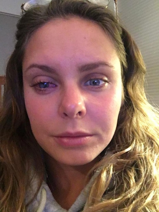 Laura Hawkins suffers from an eye infection