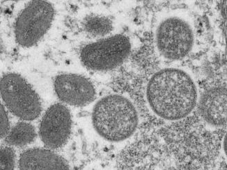 Second person in US dies after contracting monkeypox