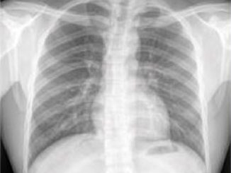 Normal Chest X-Ray