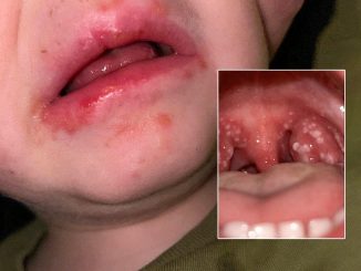Strep A: Fifteen children have died in the UK in recent weeks.  Could an outbreak in the US follow?